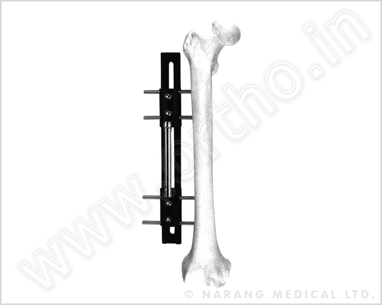 Bone Lengthening Fixator Type B